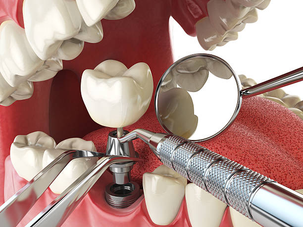 Best Emergency Wisdom Teeth Removal in Marshall, MO