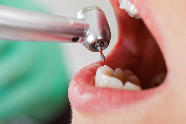 Best Emergency Tooth Extraction in Marshall, MO